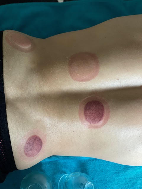 Cupmarkeringen op de rug na een behandeling