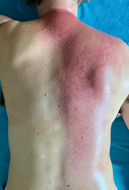 Rug met roodkleuring direct na een cuppingbehandeling